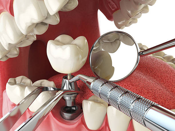 Best Knocked-Out Tooth Emergency  in Berkley, CO
